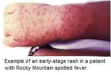 Example of an early-stage rash in a patient with Rocky Mountain spotted fever (RMSF)